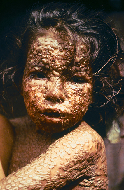 This is the face of smallpox